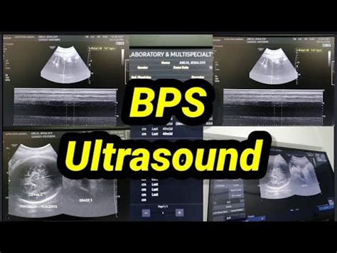 what is bps ultrasound|Ultrasonography in Biophysical Profile: Practice Essentials.